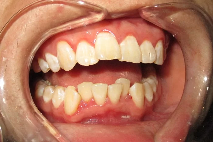 bệnh lý nha khoa thường gặp ở trẻ răng mọc lệch